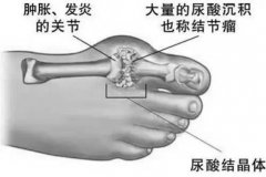 氢水对高尿酸血症有疗效