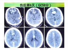 miR-21在氢气保护创伤性脑损伤中作用机制研究