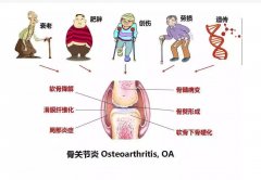 氢气饱和等渗盐水腹腔注射治疗兔创伤性关节炎的实验研究