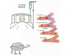 氢动力微马达在急性缺血性脑卒中的精准