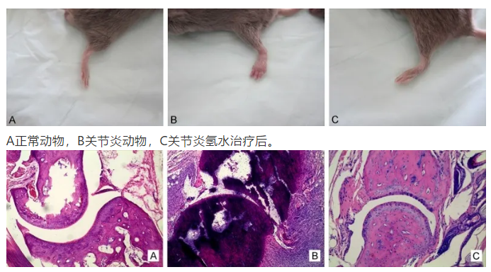 氢水改善类风湿关节炎的研究