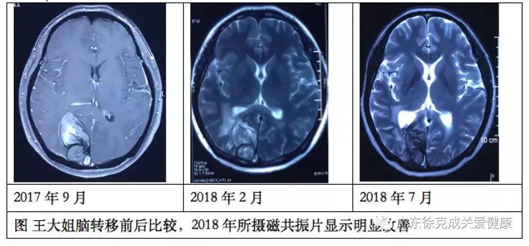 临床报告显示｜吸氢后，肺癌脑转移完全消失了。