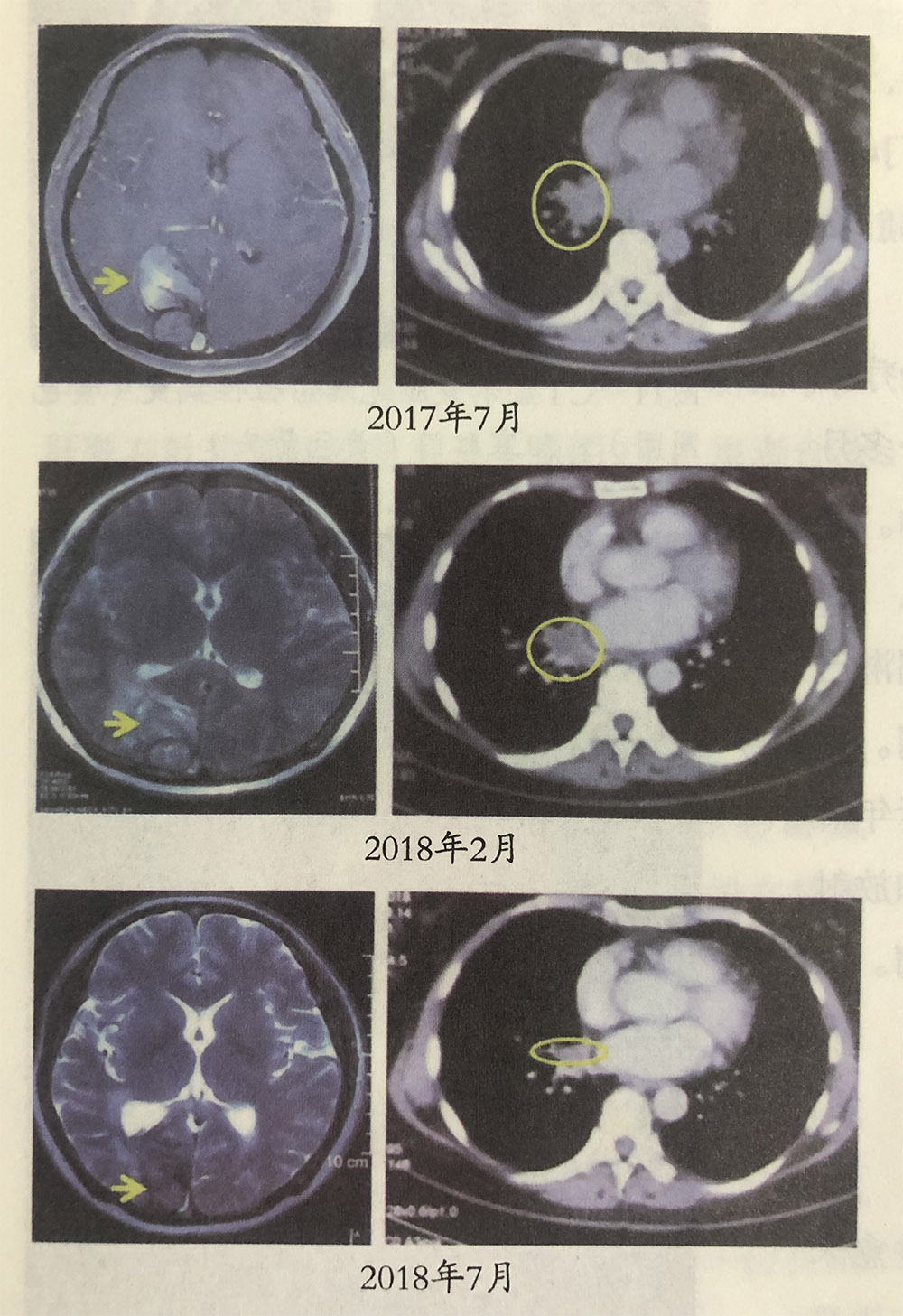 非小细胞性肺癌伴脑转移