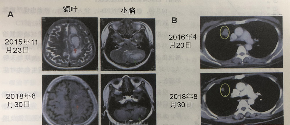 右肺上叶腺癌cT2aN2M1b IV期伴脑转移