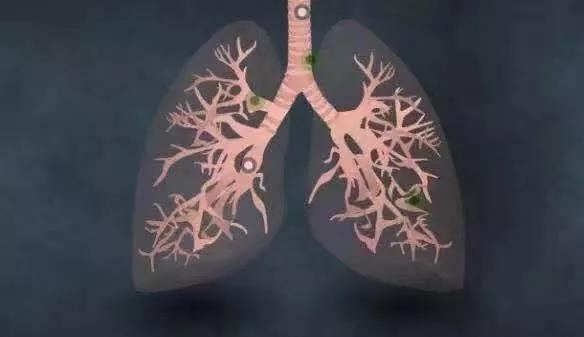 氢案例|肺癌患者家属的陪护日记：吸氢是应对预后的有效手段