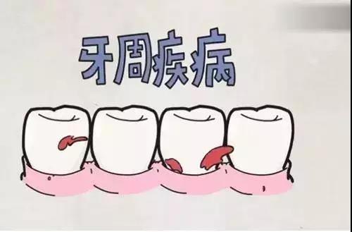 富氢水对牙龈氧化应激和牙槽骨吸收的预防作用