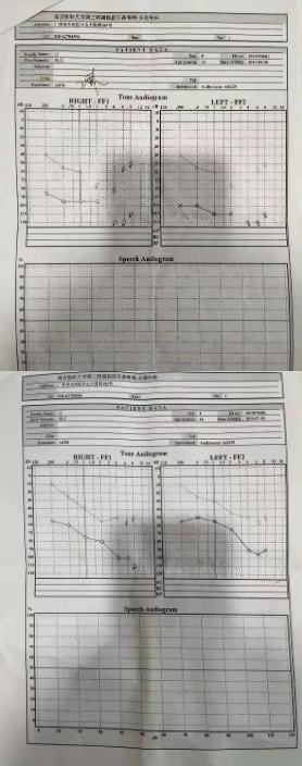 改善副作用让她几度轻生，吸氢让她焕发新生