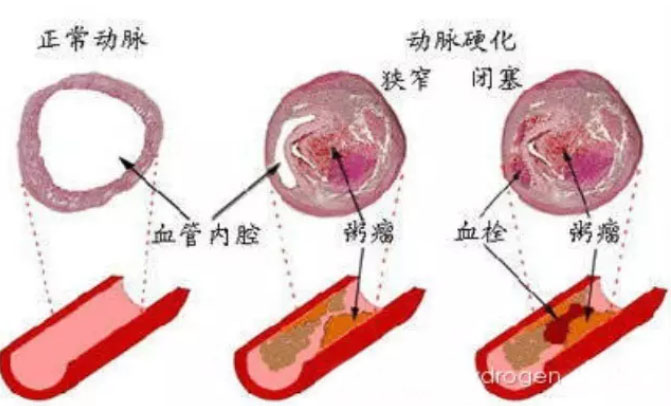 动脉硬化也存在氧化损伤，也是炎症性疾病，氢气有预防动脉硬化可能