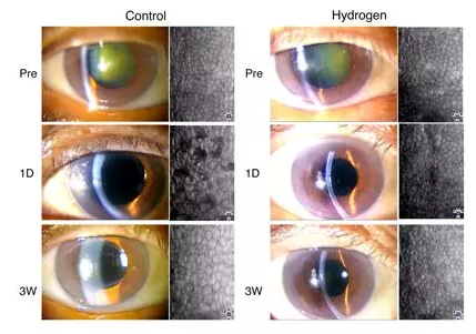氢气预防白内障手术角膜损伤（眼科临床