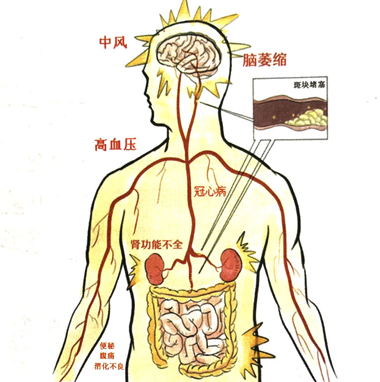 动脉粥样硬化的主要危害