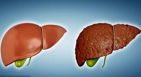 长海医院：氢水改善脂肪肝的研究