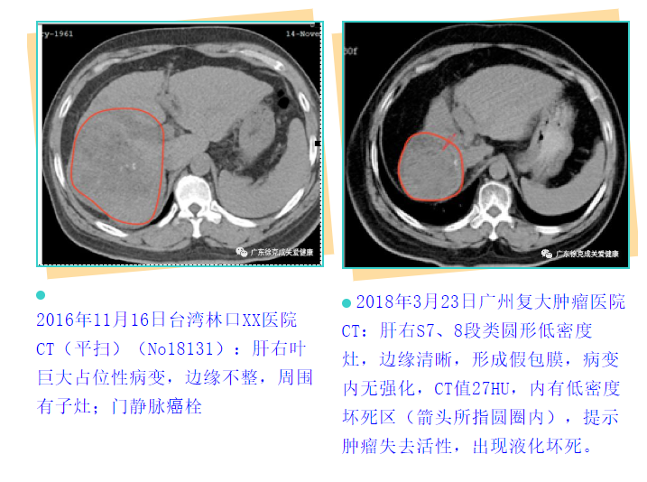 吸氢控癌病人回访｜他说：五年后会向医生说出这个“秘密”