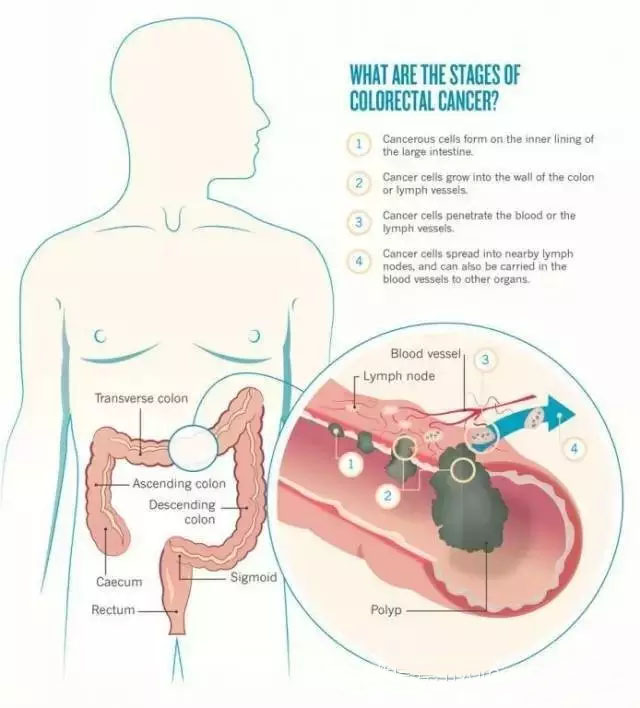 预防结肠癌的秘密武器：氢水