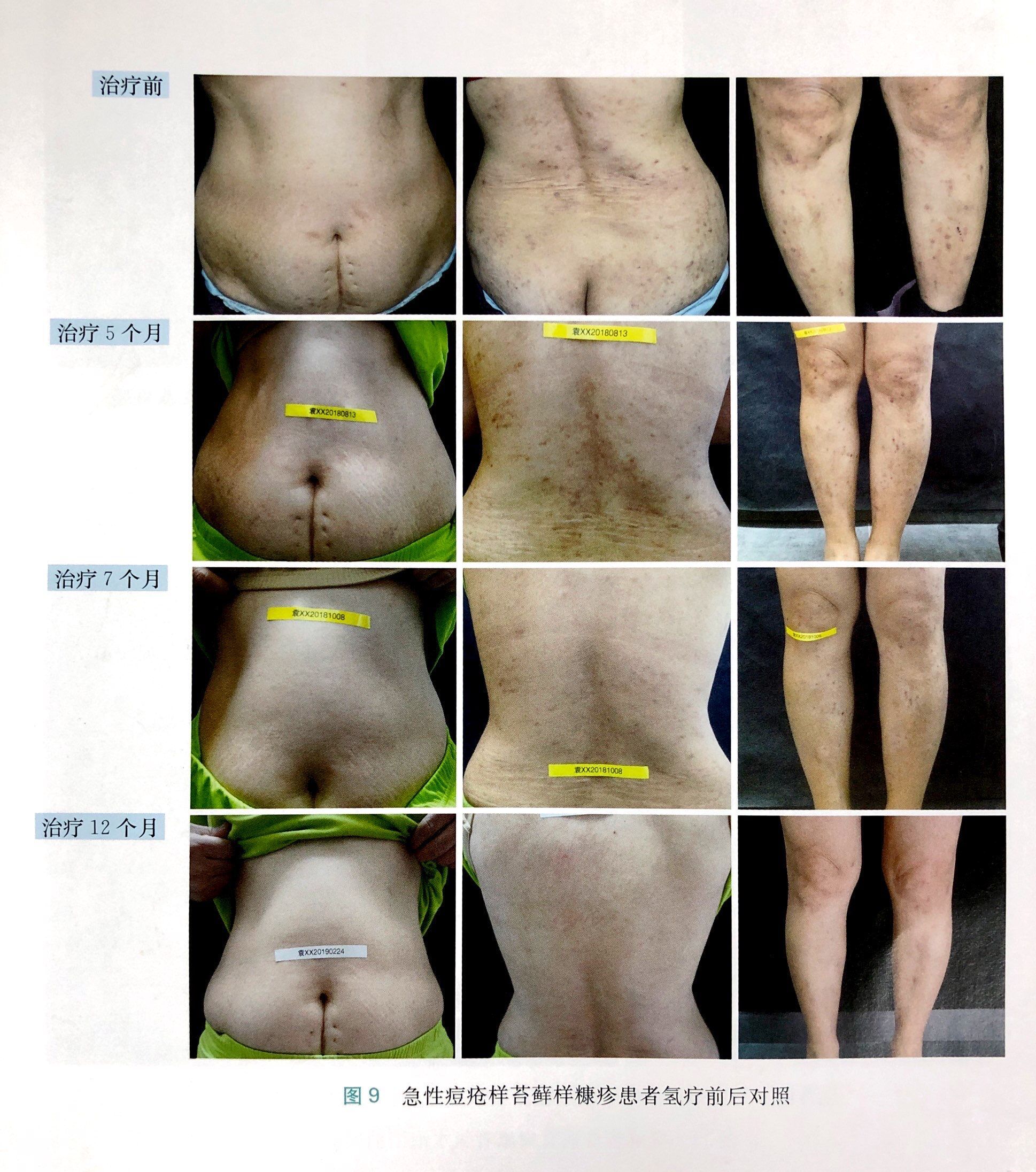 急性痘疮样苔藓样糠疹的改善案例