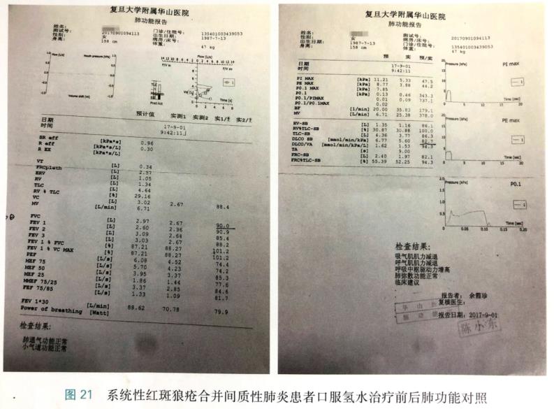 氢气改善结缔组织病相关间质性肺疾病