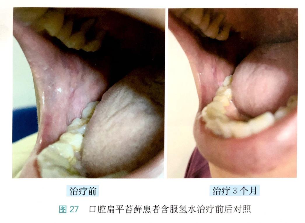 富氢水改善口腔扁平苔藓的病例