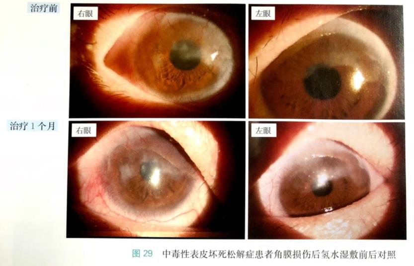 氢气水改善角膜损伤的病例分享