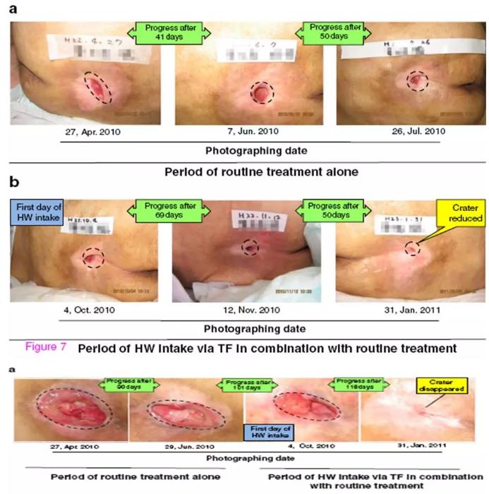 氢水改善褥疮的研究报道