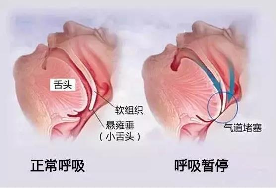 打呼噜是病！可以用氢气改善看看