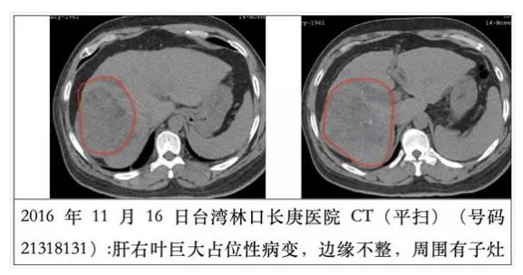 氢改善癌症：他患肝癌，改善很顺畅