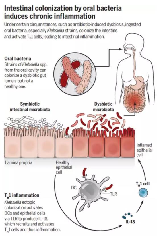 报道口腔肺炎球菌能导致结肠炎，氢气水漱口可能是理想的办法