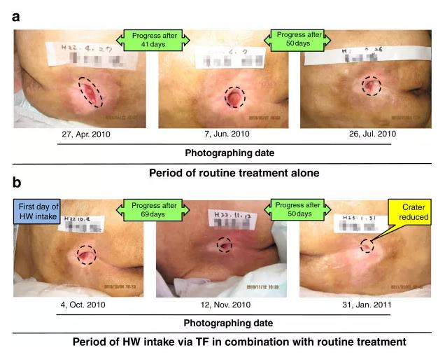 饮用氢水治疗褥疮临床试验