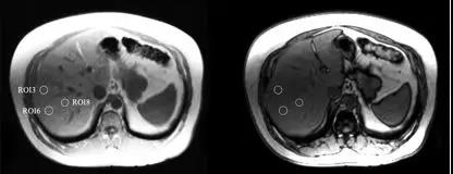 MRI显示氢水饮用前后肝脏脂肪含量的改变