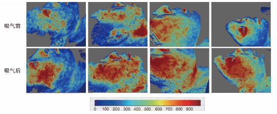 吸入氢氧混合气后，志愿者面部皮肤血流明显增加