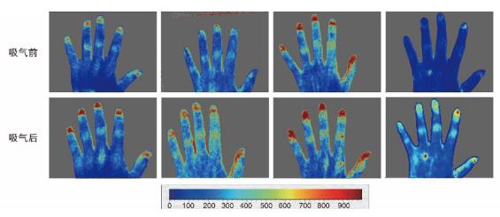 吸入氢氧混合气促进手部皮肤血流吸入氢氧混合气后，志愿者手背部皮肤血流明显增加
