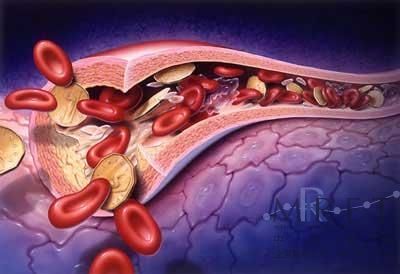 高血脂，特别是低密度脂蛋白高，和动脉硬化存在密切关系，这已经是常识