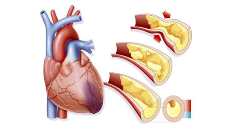 氢气在心肌缺血急救中的应用研究