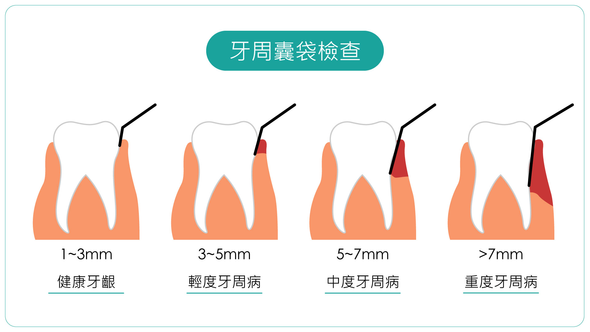 牙周囊是牙周病常見的徵狀，氫氣能有效減緩此症狀。