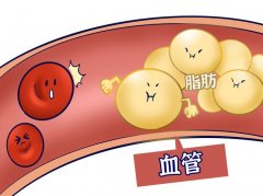 氢气对高血脂有什么作用？氢气对高血脂的研究概述