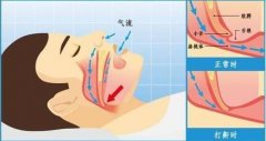 氢气吸入治疗呼吸暂停综合征