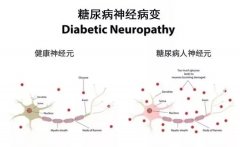 氢对糖尿病周围神经病变具有显著的保护作用