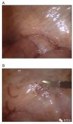 氢气对腹膜透析包裹性腹膜硬化症的案例