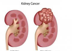 氢水对对肾肿瘤患者术后肾功能恢复的86例临床研究
