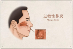 过敏性鼻炎吸氢竟然有效！