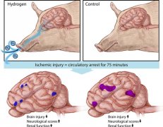 氢气保护新生儿大脑