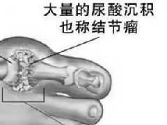 【临床】301医院临床研究证实｜氢水对痛风有明显疗效