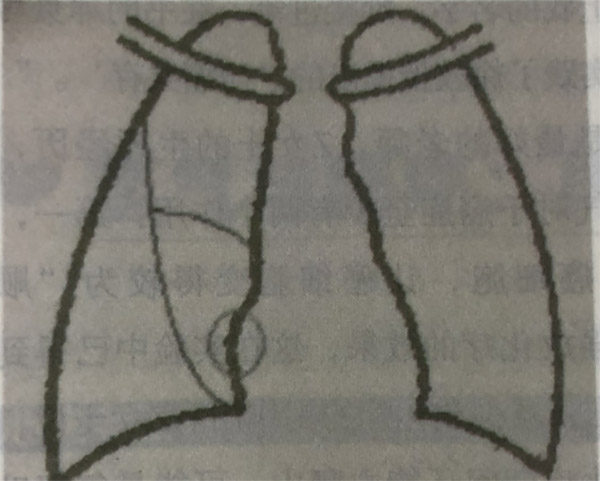 氢气与肺癌:白挨一刀